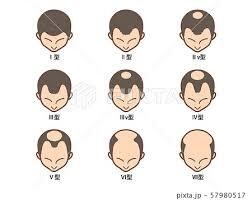 AGA治療のアイキャッチ画像