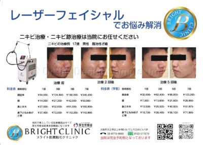 ニキビ治療はじめました！のアイキャッチ画像