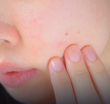 ニキビ・ニキビ跡