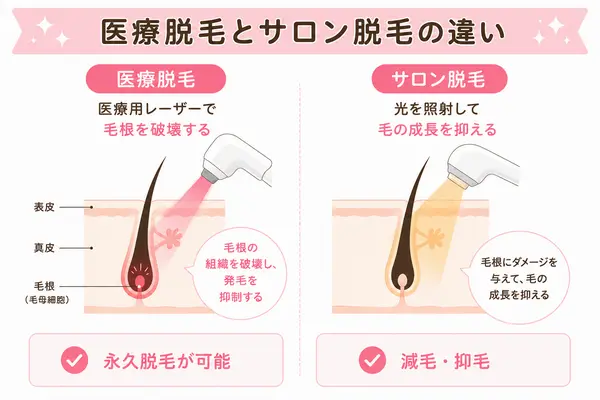 医療脱毛とサロン脱毛の違い